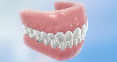 Invisalign G3 d'Align Technology pour lutter contre les malocclusions