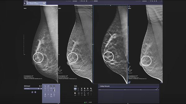 La tomosynthèse mammaire HD, une nouvelle dimension de la mammographie