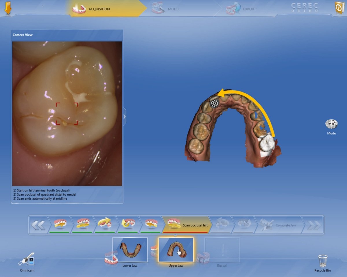 Logiciel CEREC Ortho : empreintes numériques pour indications orthodontiques