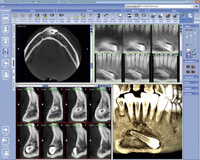 Logiciel dentaire d'imagerie 3D Planmeca Romexis