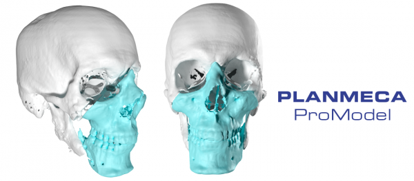 Planmeca et sa technologie 3D utilisés pour une greffe de tissu facial
