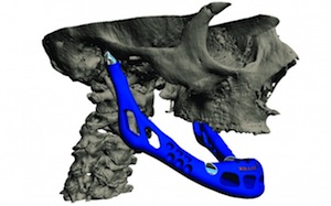 Reconstruction mandibulaire totale : LayerWise réalise le premier implant personnalisé