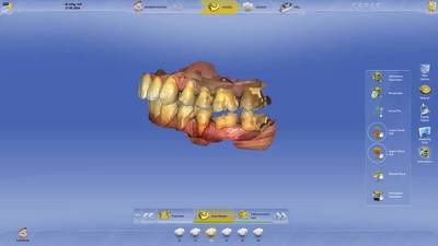 Sirona associe innovation et facilité d'utilisation avec le nouveau logiciel dentaire CEREC 4.3 